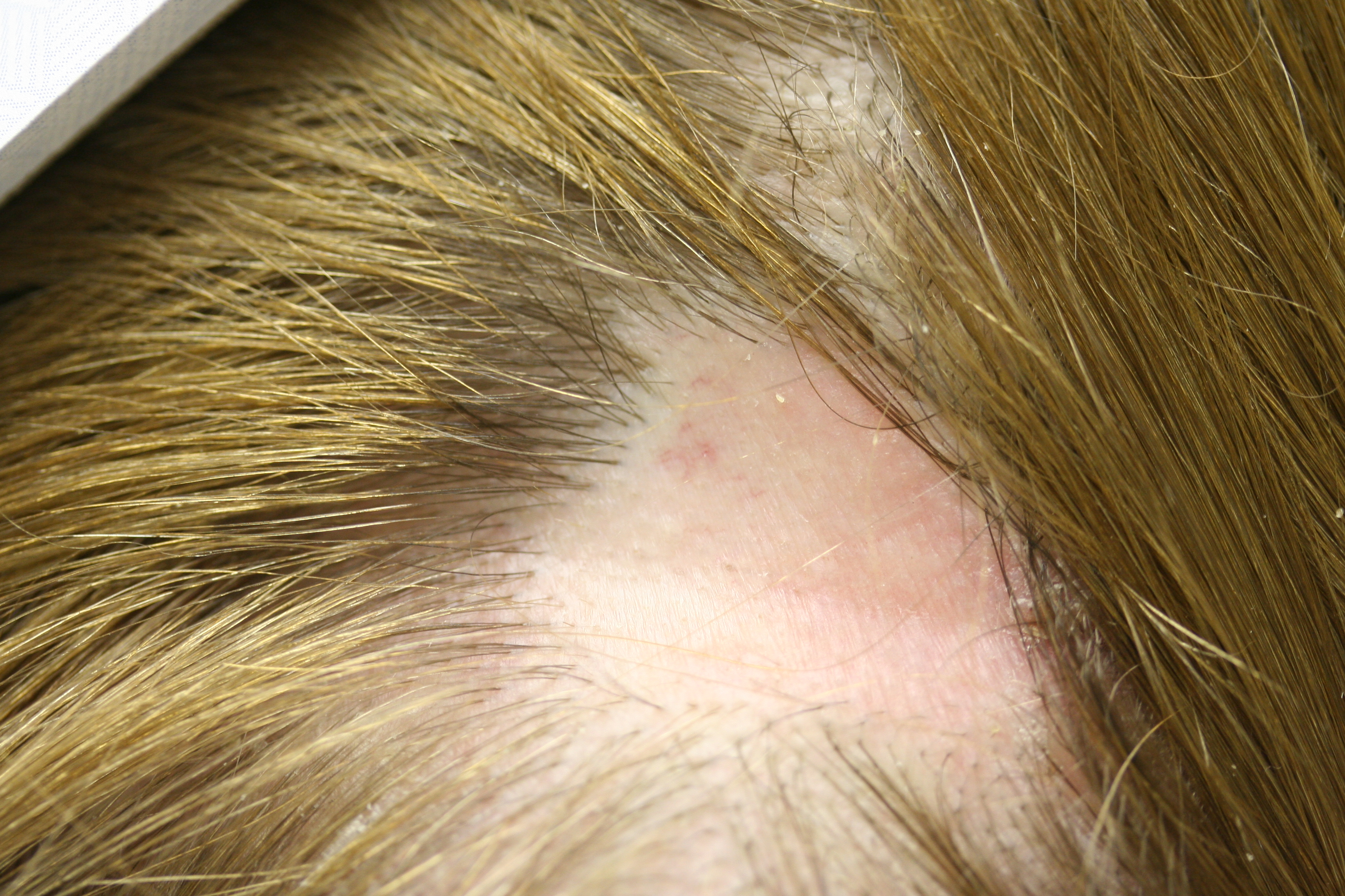 Alopecia areata.  Localized hair loss usually does not evolve into alopecia totalis for most patients.