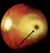 Fundus picture showing cherry red spot in a 9-month-old boy with Tay Sachs disease