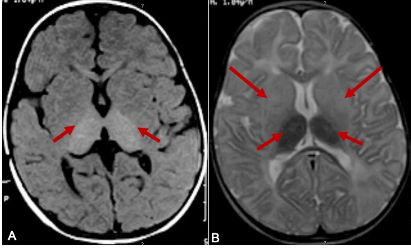 Brain MRI in a 9-months-old boy with Tay Sach's disease. A. T1 weighted axial image showing hyperintensity of the thalami (Arrows). B. T2W axial image shows hypomyelination , hyperintense signal changes in basal ganglia (Arrows) and hypointense signal changes in thalami (small arrows).
