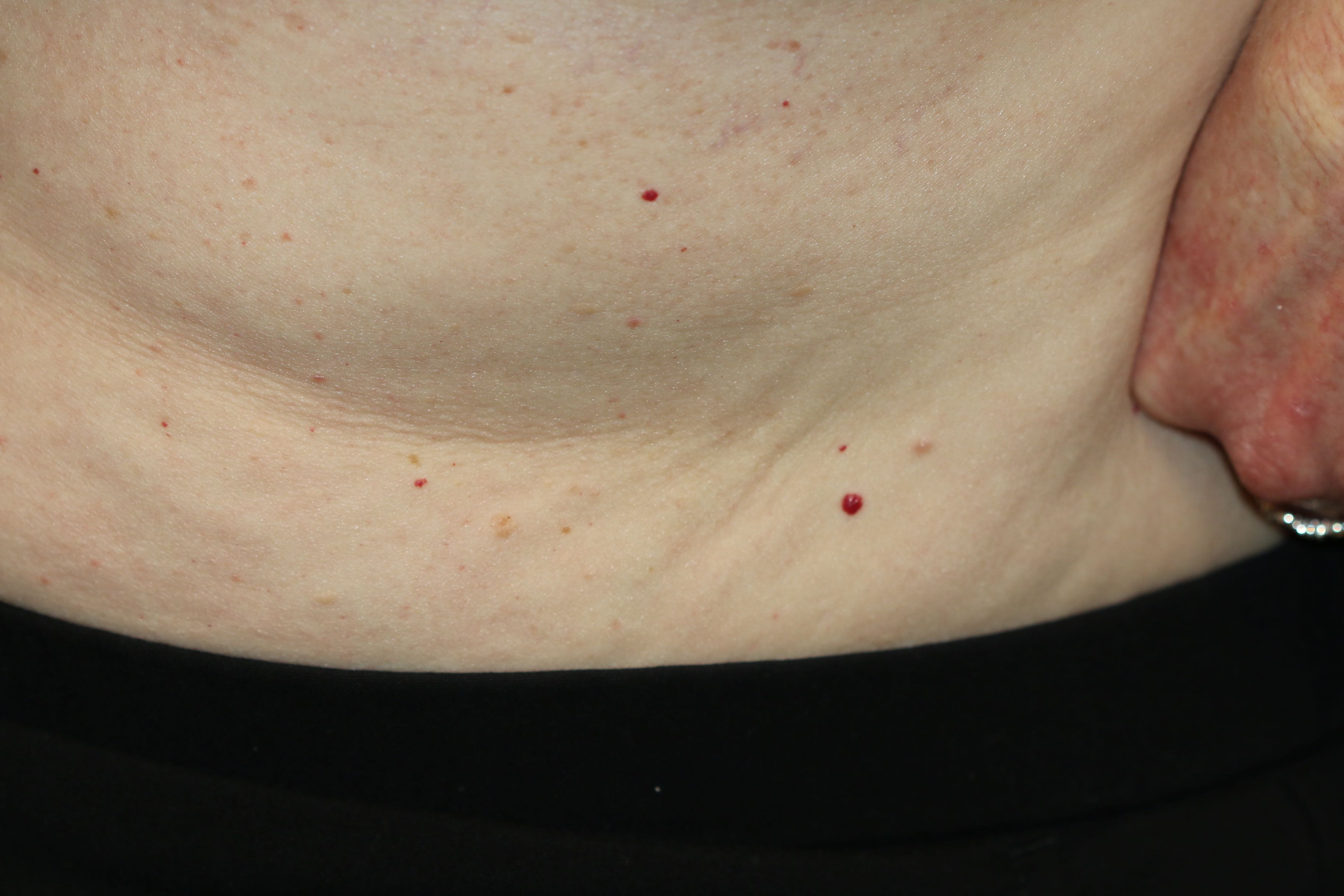 Campbell de Moran spots (cherry hemangiomas) on the trunk of a 78-year-old female