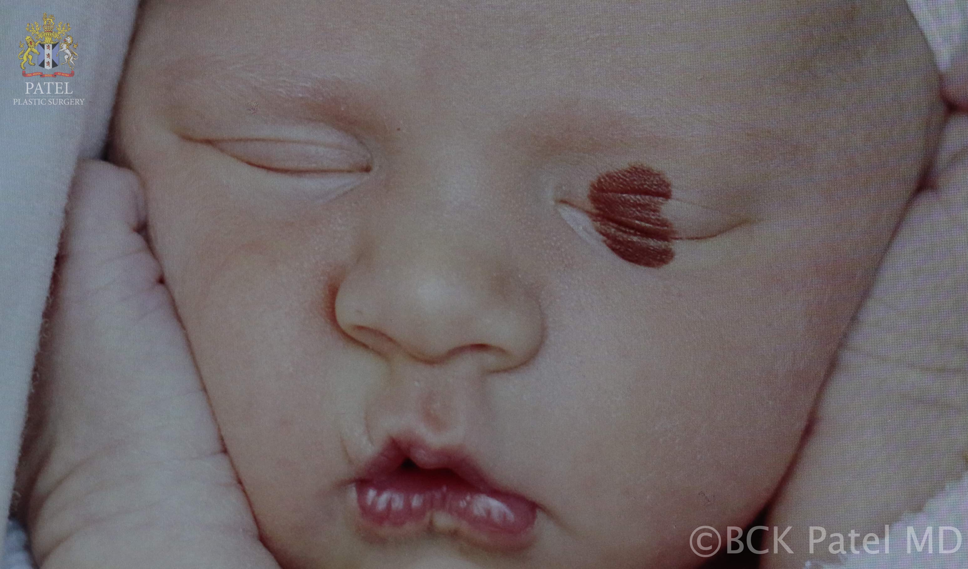 Congenital melanocytes nevus: also known as a "kissing nevus" in a newborn