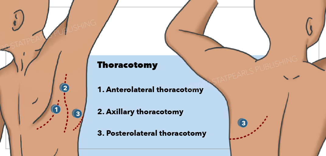 Thoracotomy, Posterolateral thoracotomy, Axillary thoracotomy, Anterolateral thoracotomy