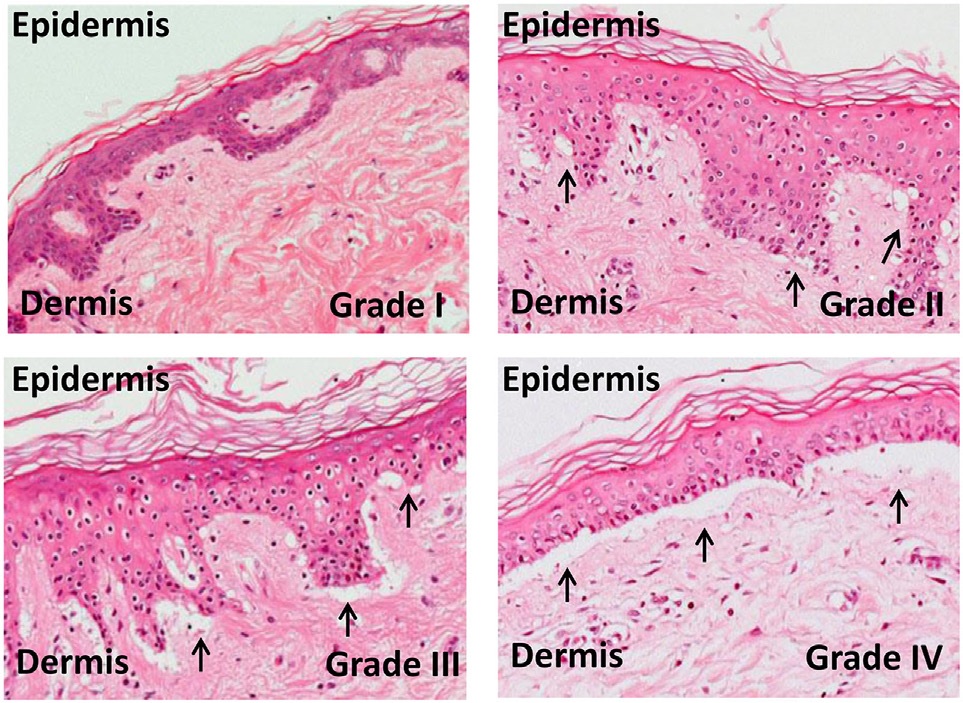 Grades of skin graft vs host disease