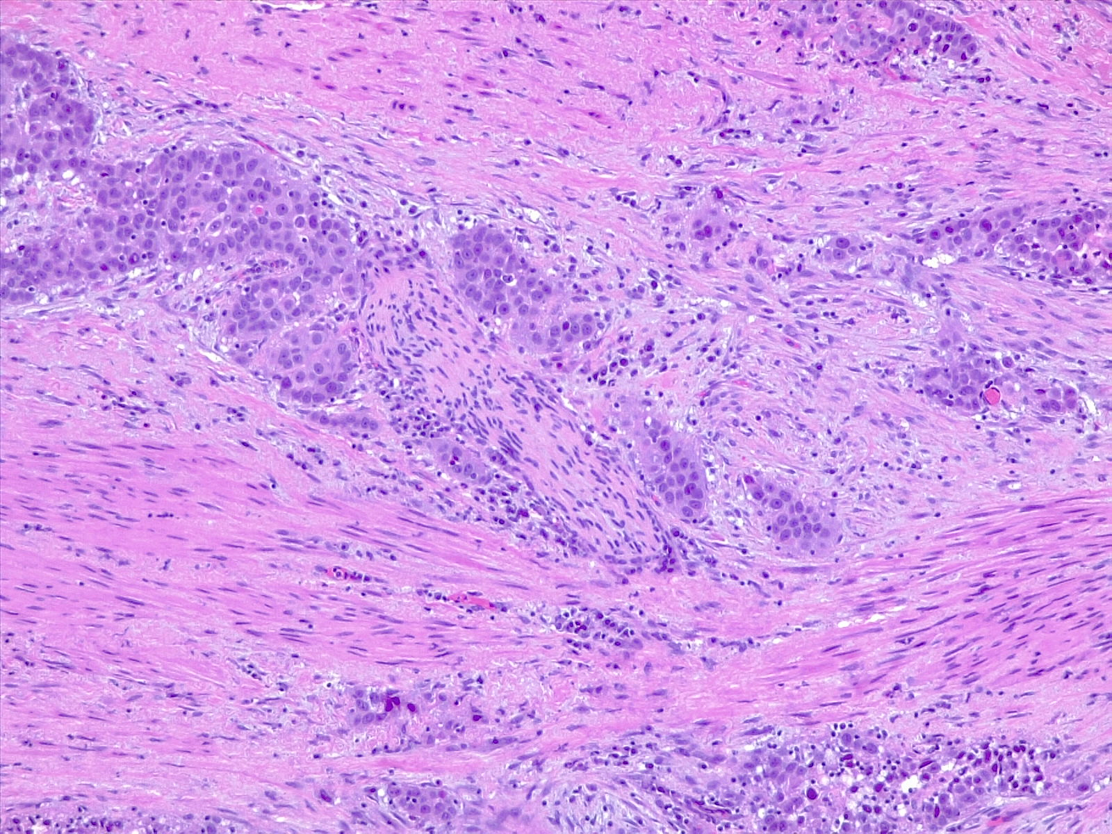 Urothelial carcinoma, perineural invasion. 10x H/E