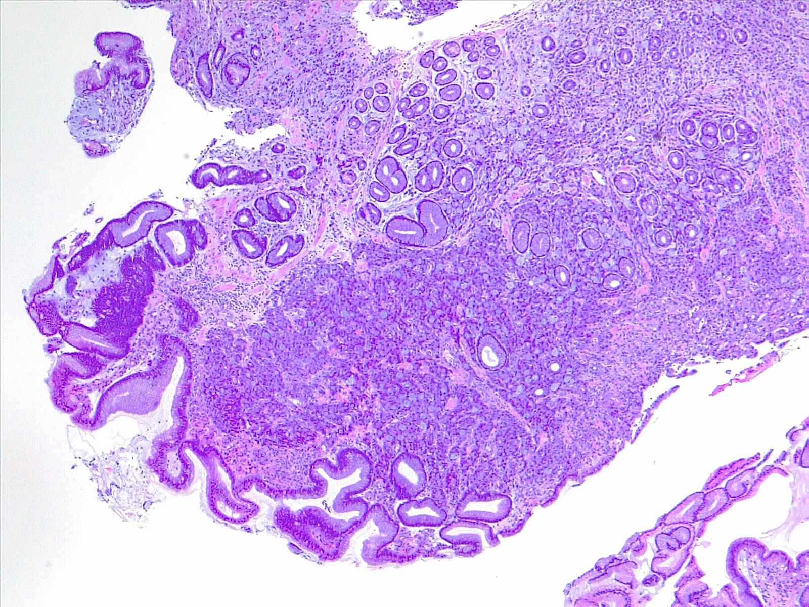 Gastric carcinoma, signet ring type, diffuse gastric cancer. 4x H/E