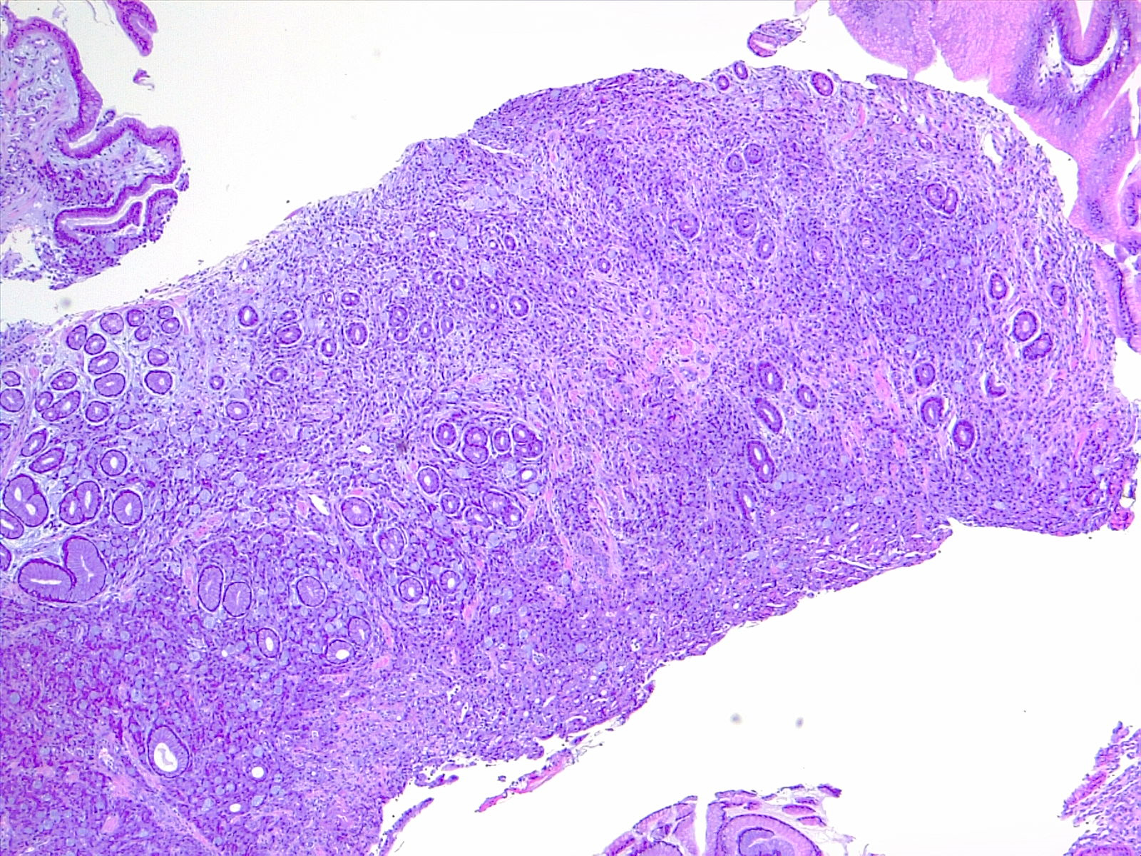 Gastric cancer, signet ring type. Diffuse carcinoma of the stomach. 4x H/E