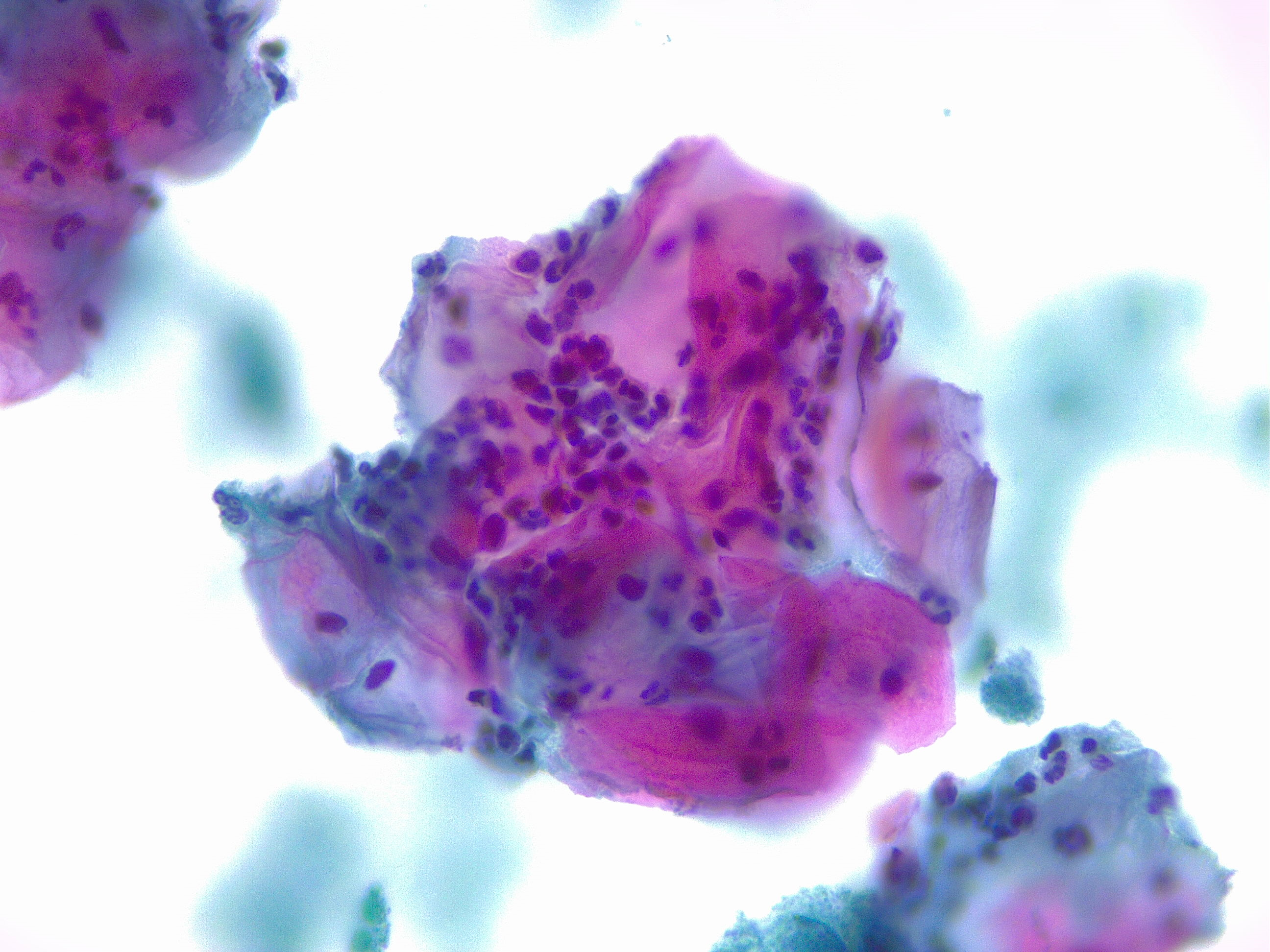 Squamous cells, acute inflammation. Cytology, papanicolaou stain 40x