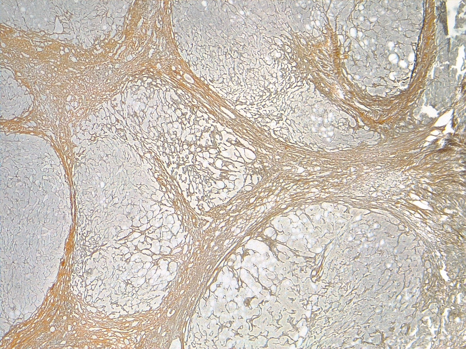 Cirrhosis, liver. Reticulin stain enhances the fibrous septa dividing the hepatic nodules. 4x.