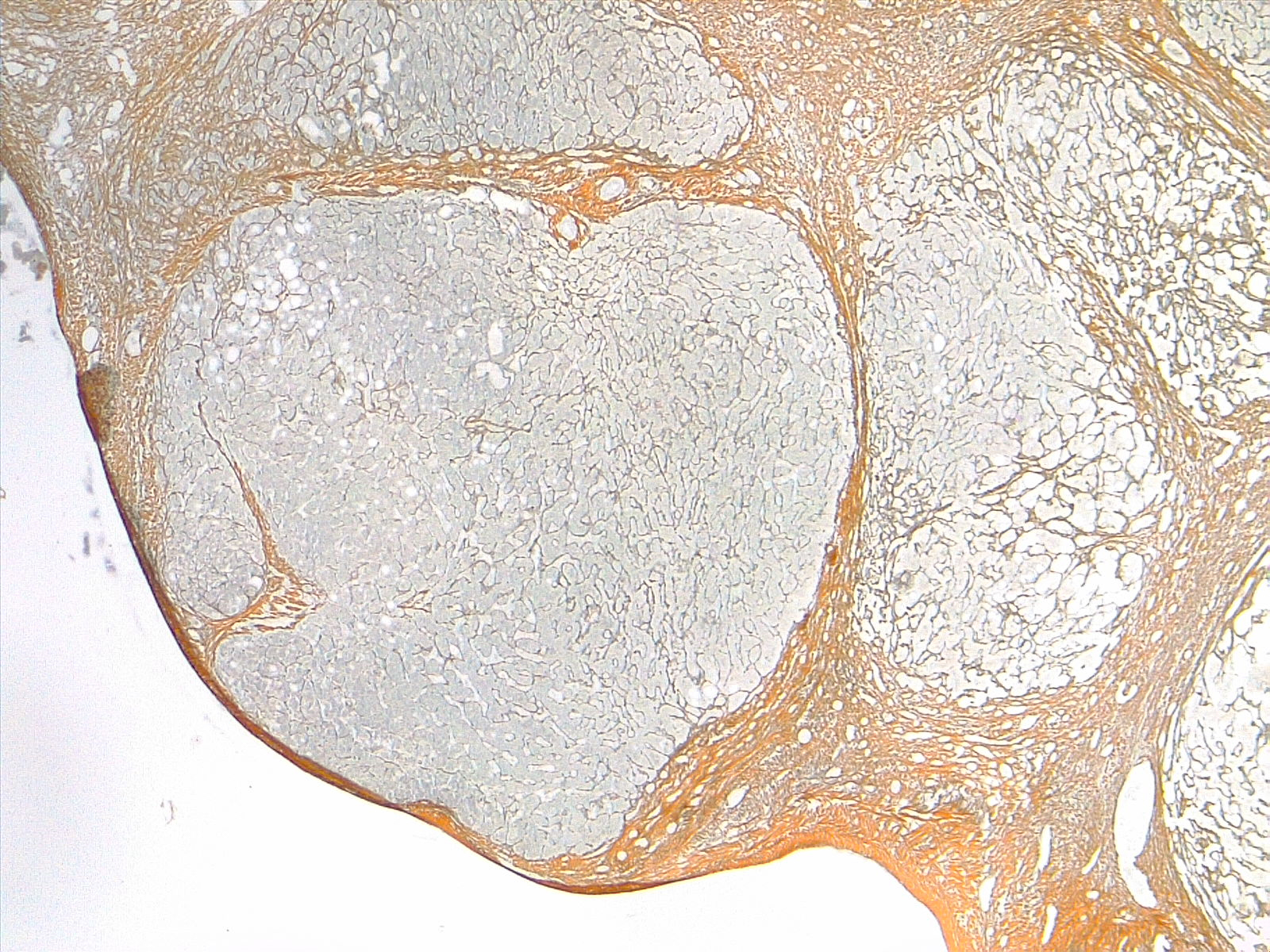 Liver cirrhosis, reticulin stain 4x