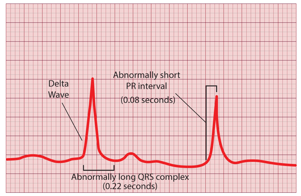 Wolff-Parkinson-White-Syndrome, Delta Wave, Abnormally short PR interval, Abnormally long QRS complex