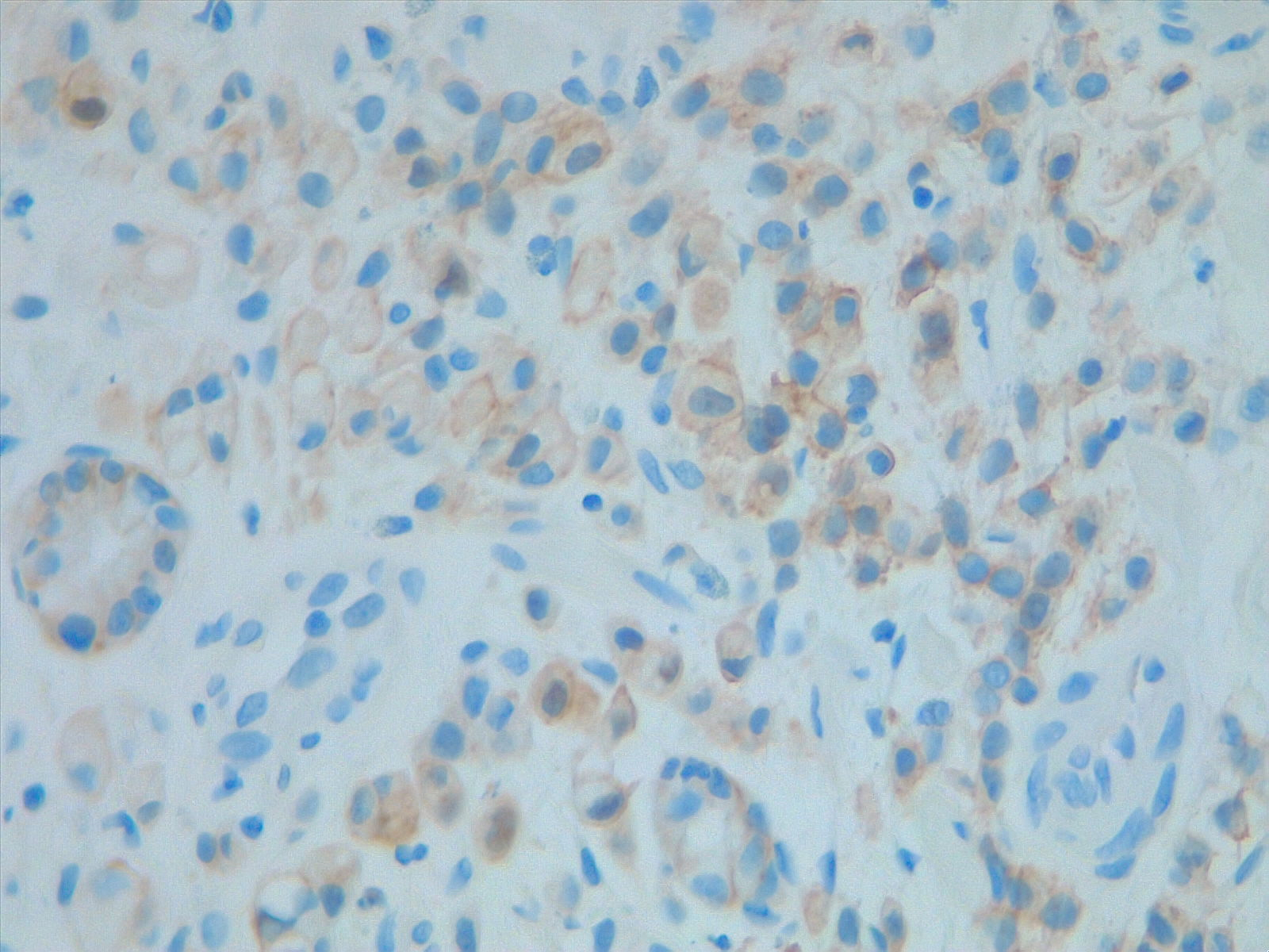 Prognostic and predictive HER2 analysis is crucial for gastric cancer treatment. Correct HER2 evaluation can select patients for target-treatment. Here, immunohistochemistry is performed and graded as 1+ ("staining is weak or detected in only one part of the membrane of at least 5 cohesive cells")