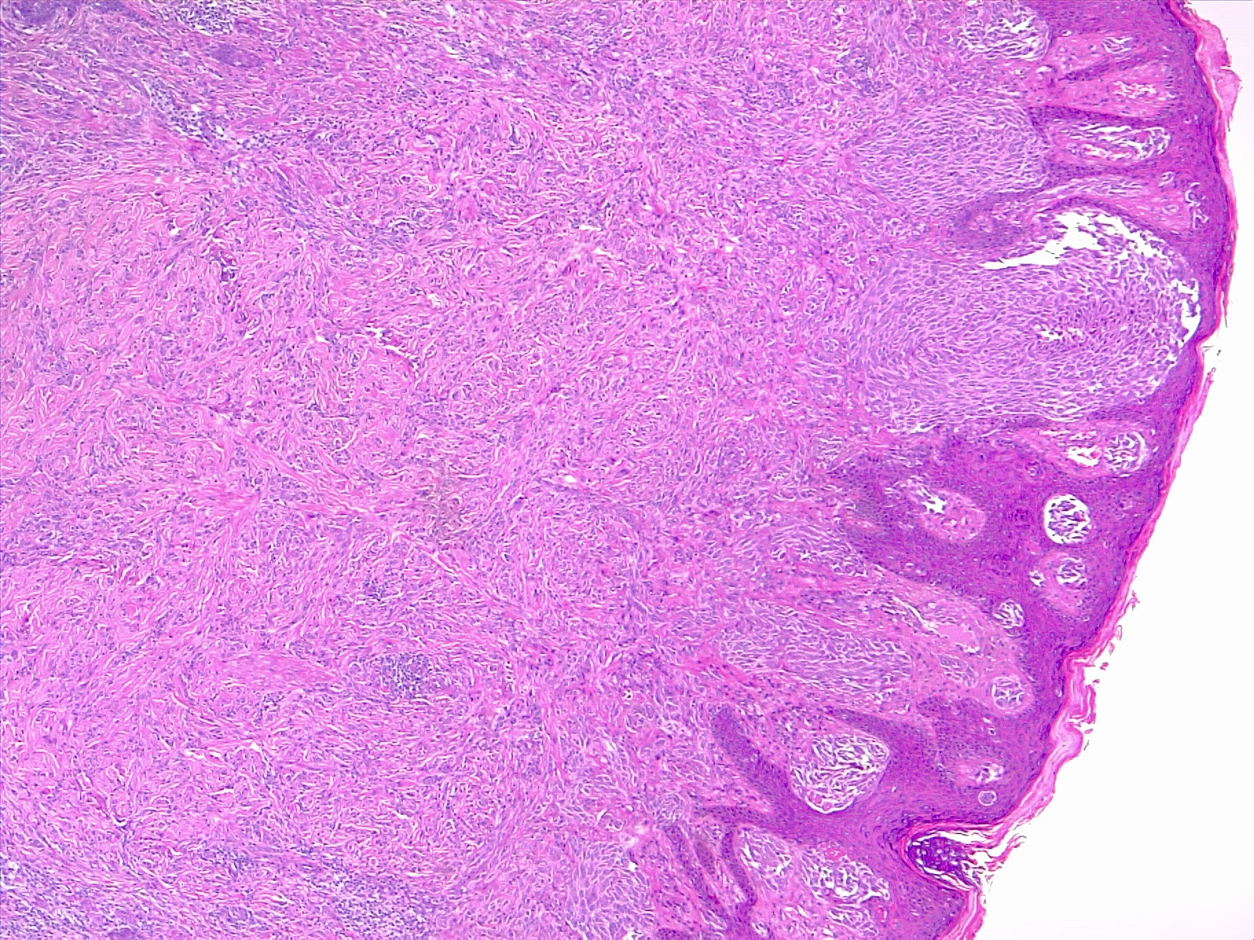 Atypical proliferation of melanocytes in the dermis, in a diffuse pattern. The architecture is altered, epidermal invasion and erosion. Melanoma. H/E 4x