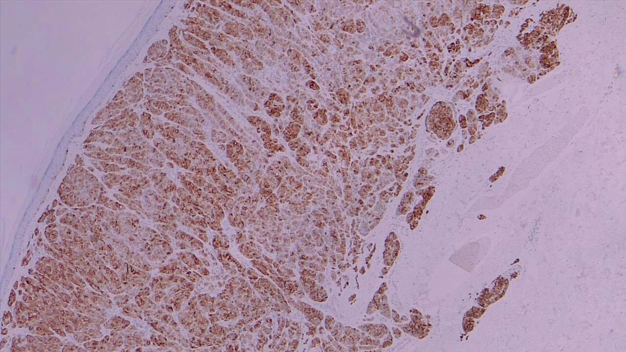 Melanoma of the skin. Malignant melanocytic proliferation enhanced by MART1 / MELAN-A immunohistochemical stain, with deep dermal invasion. 4x