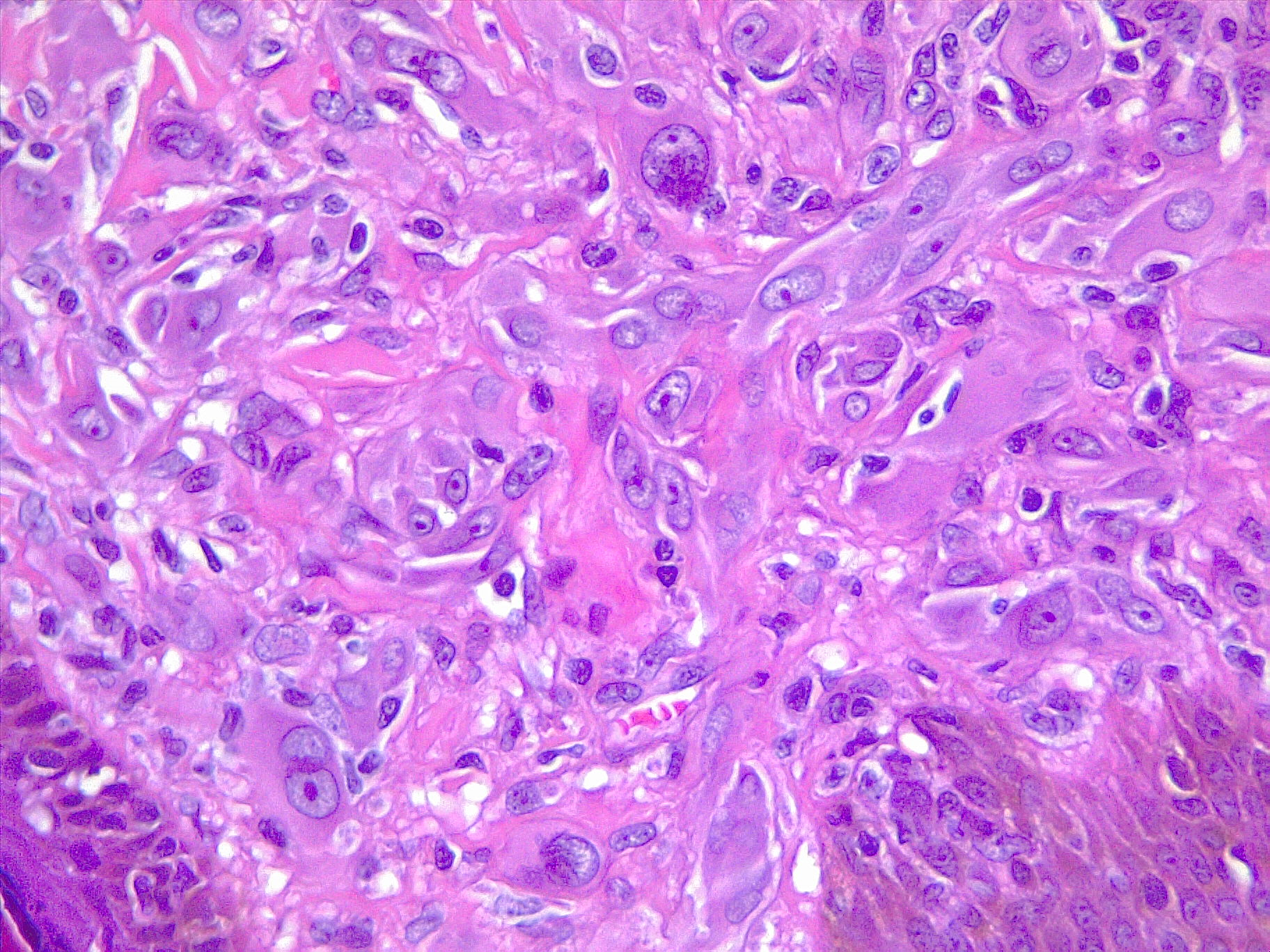 Spitz melanoma of the skin. Highly atypical melanocytes in the dermic component. H/E 20x