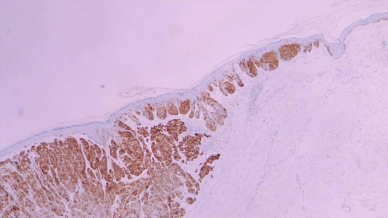 Melanoma in situ (right field) and malignant melanoma with dermal invasion. MART1 immunohistochemistry 4x