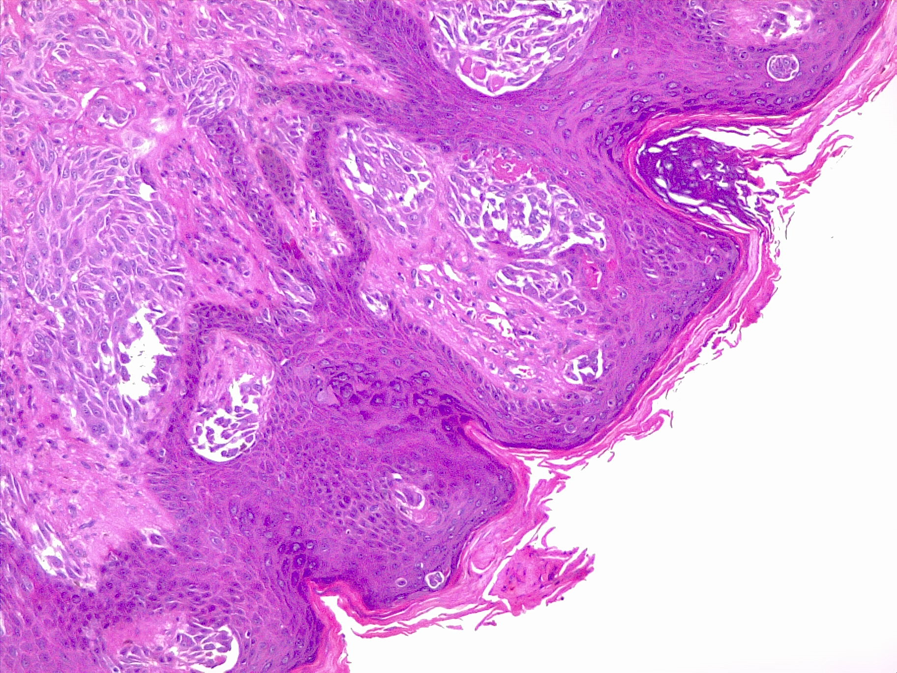 Malignant melanoma. In this 10x field is shown the superficial spread of atypical melanocytes invading the epidermis.
