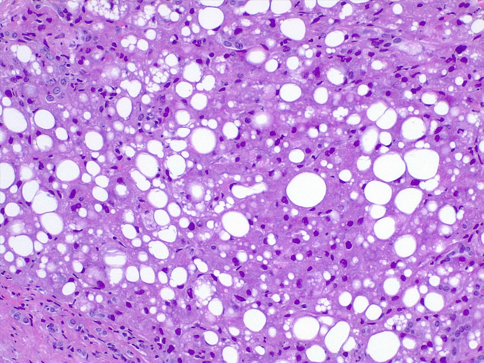 Fatty liver disease. Steatosis seen histologically as lipidic droplets (microvescicular) or a large intracytoplasmic vacuole (macrovescicular). Steatosis is quantified as percentage of altered hepatocytes in all fields.