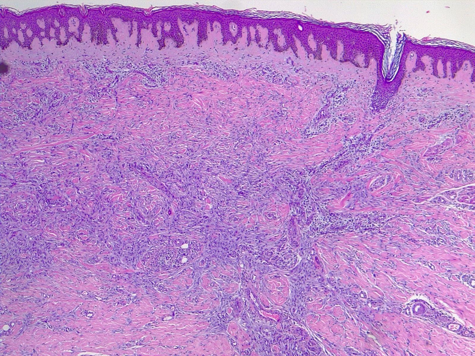 Dermatofibroma, H/E 4x. Low power view of a dermal proliferation of spindle cells entrapping collagen bundles.