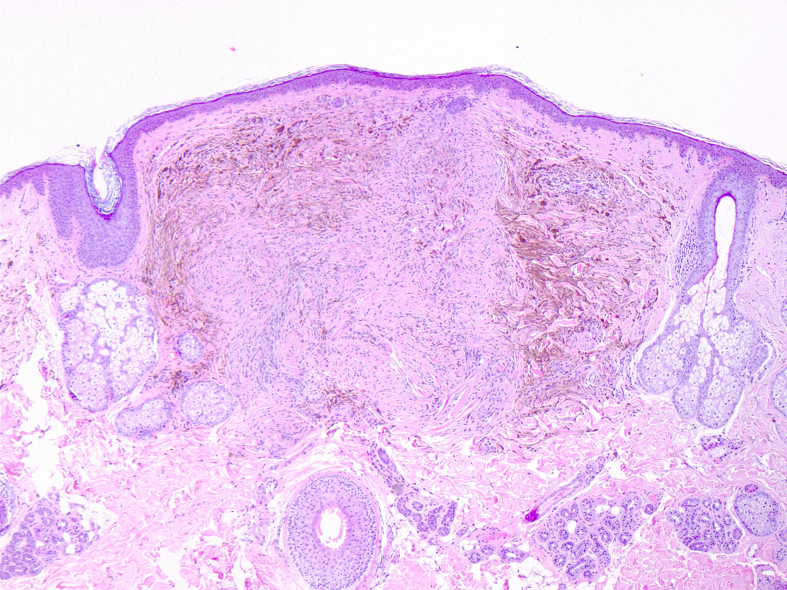Blue nevus, H/E 4x. Spindle-shaped melanocytes in upper and mid-dermis, without nest formation. Melanocytes are pigmented, show no nuclear atypia or mitoses and many melanophages are arranged between spindled-dendritic melanocytes and collagenous stroma.