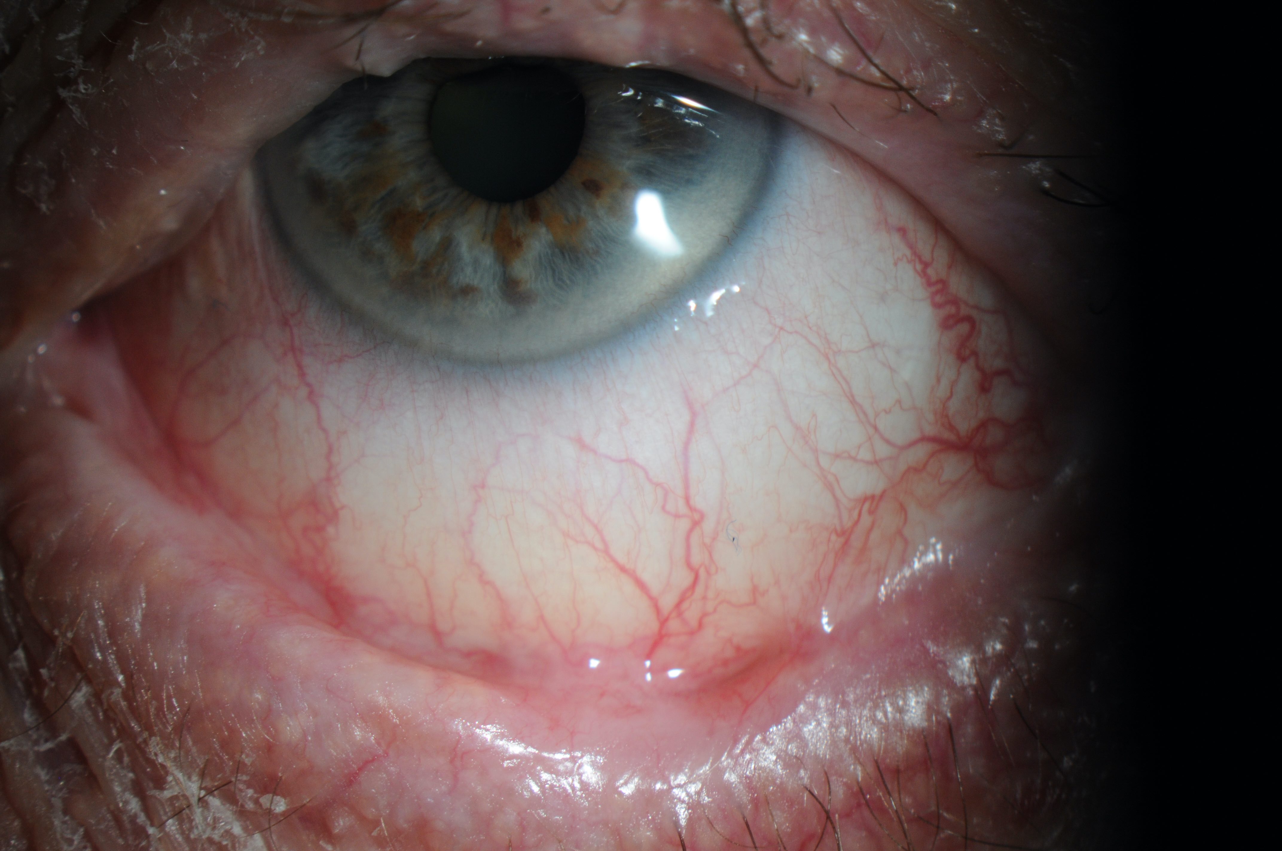 Atypical features such as chronic symptoms, relapsing/remitting course, and signs such as symblepharon, loss of the plica, shortening of conjunctival fornices suggest a non-viral cause of conjunctivitis.