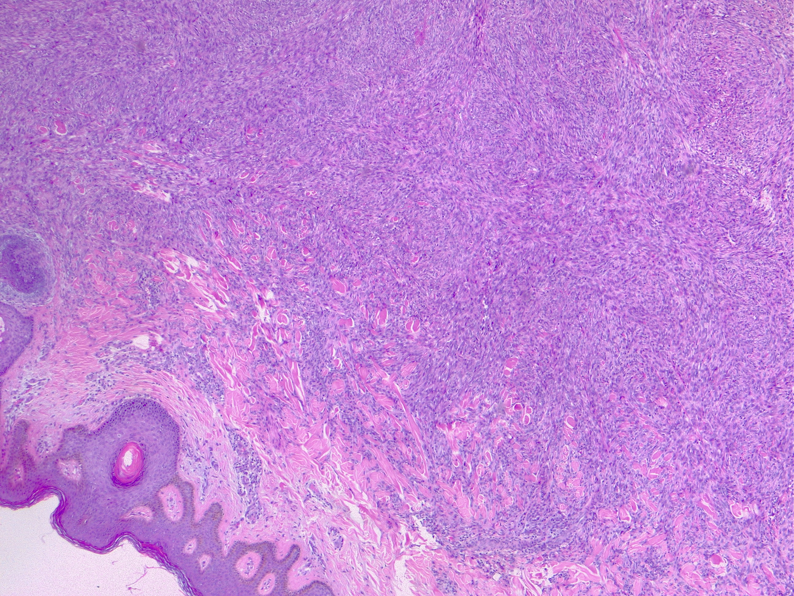 Cellular dermatofibroma, also known as cellular fibrous histiocytoma. H/E 4x.
