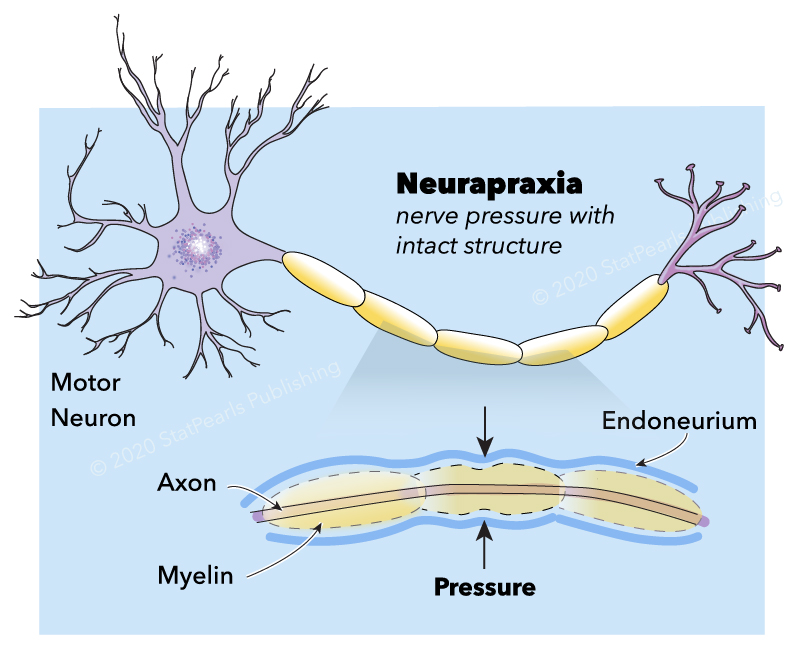 Neurapraxia, motor neuron, axon, myelin, endoneurium