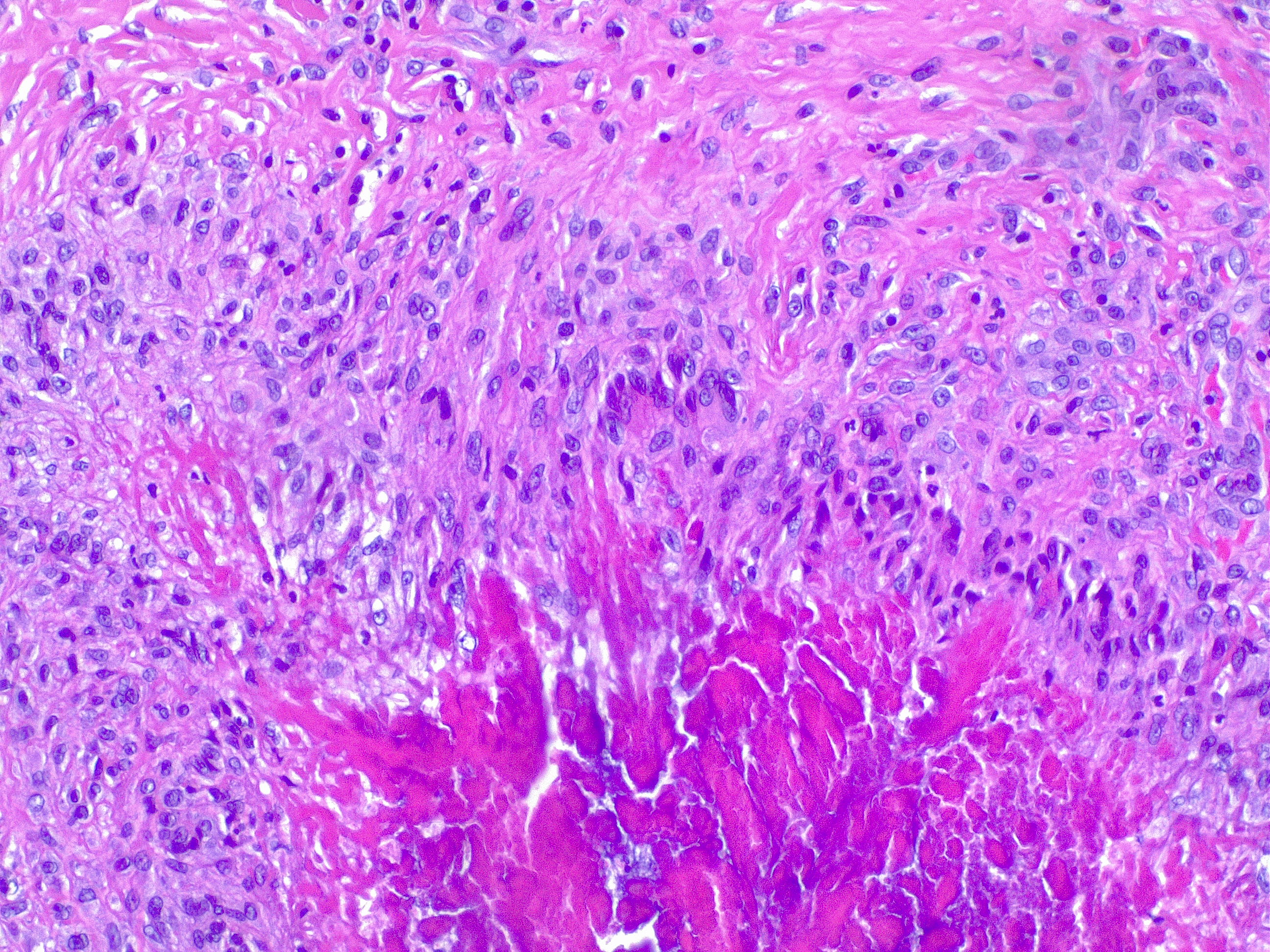 Granuloma annulare, H/E 20x. Palizading histiocytes and lymphocytes surround an area of necrobiotic collagen.