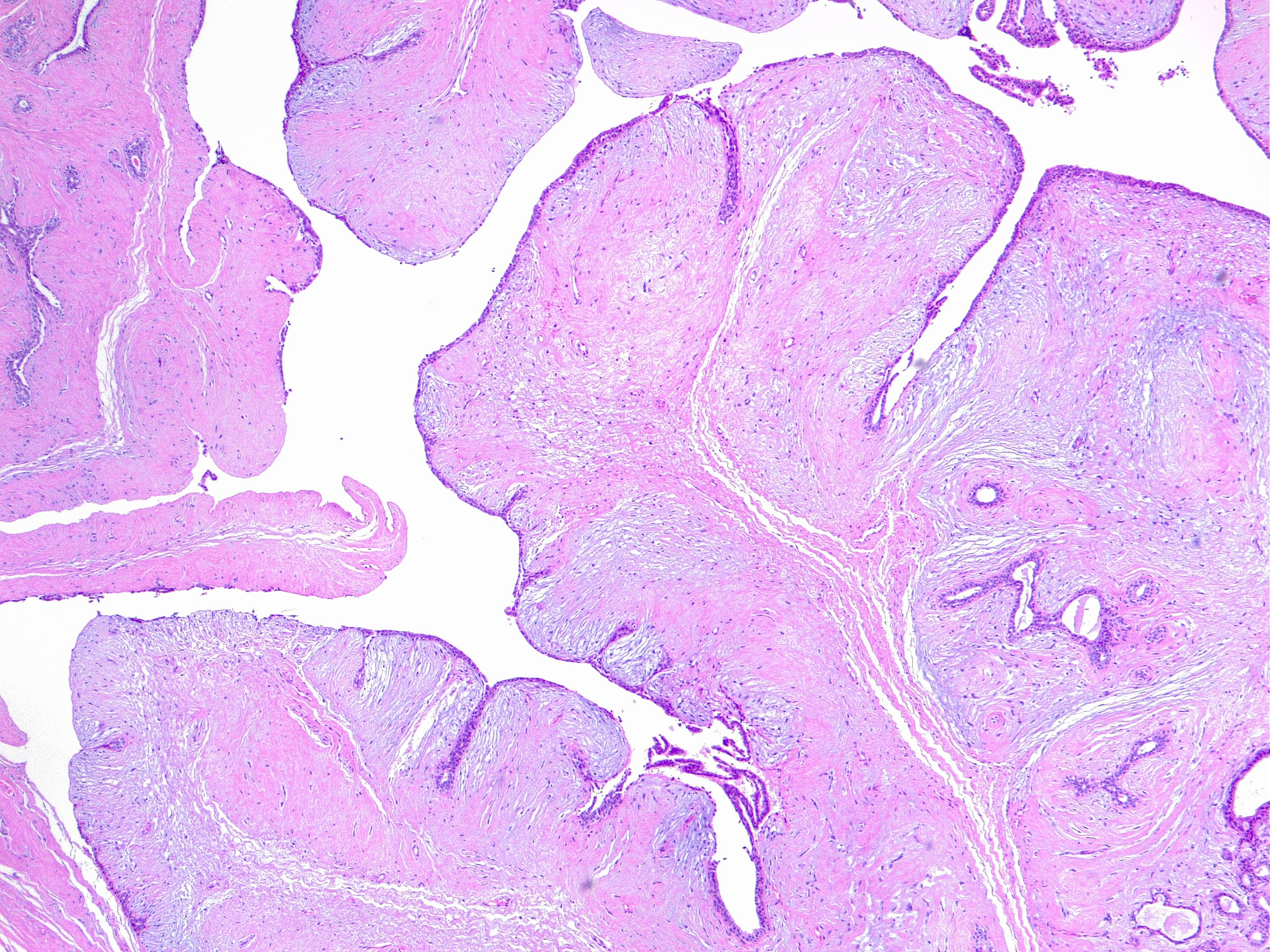 <p>Phyllodes Tumor of the Breast, Benign. H/E 4&times;</p>