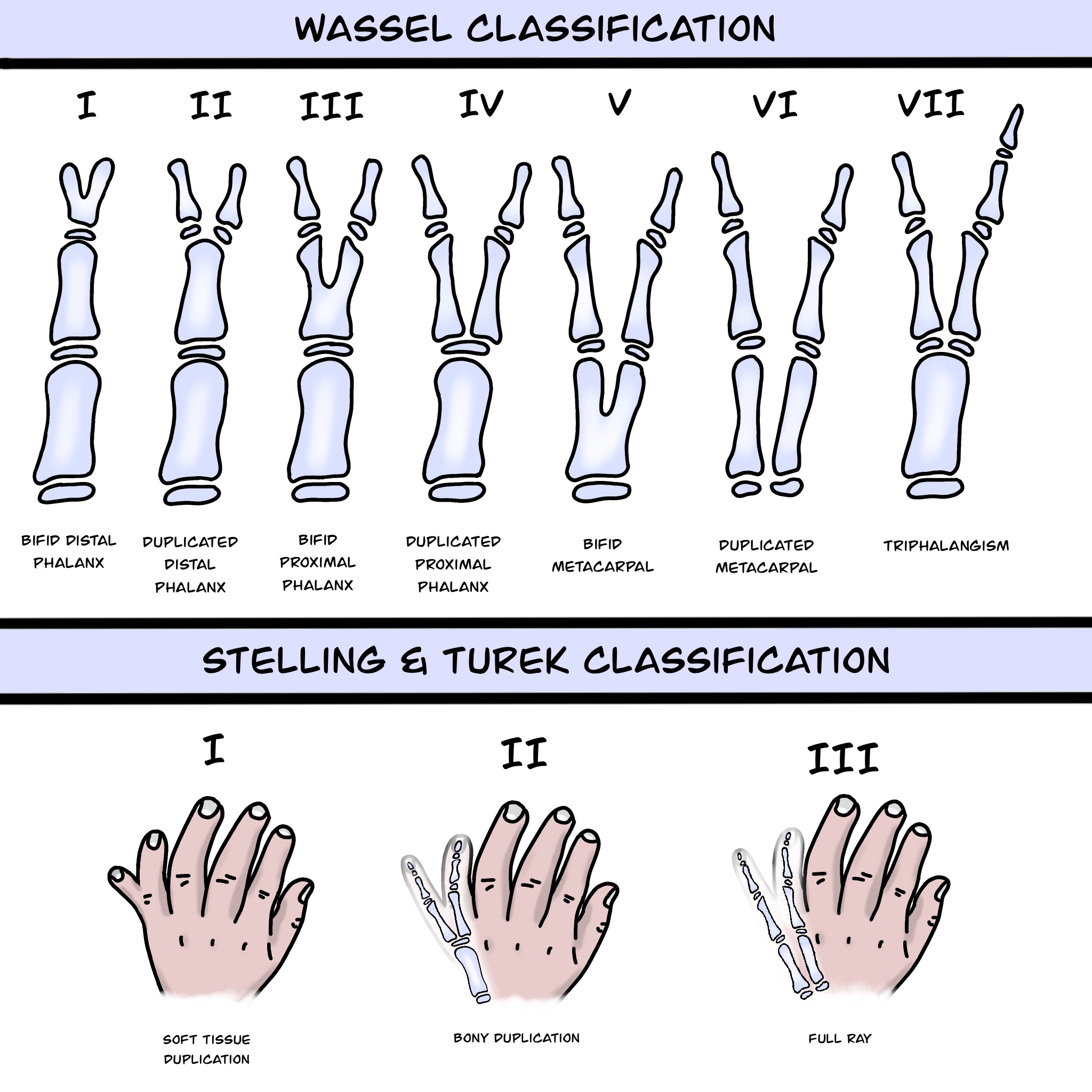 Figure 1: Preaxial and postaxial polydactyly classifications
