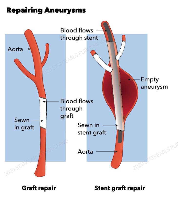 Aneurysm repair, stent, graft, aorta
