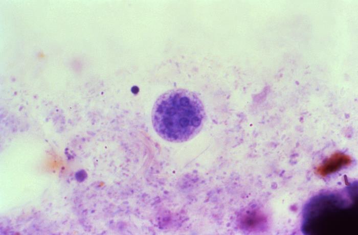 This photomicrograph of an iron-hematoxylin-stained specimen, revealed the presence of a mature, Entamoeba coli cyst, which contained five visible nuclei, each with its eccentrically located karyosome, and peripherally located chromatin.
