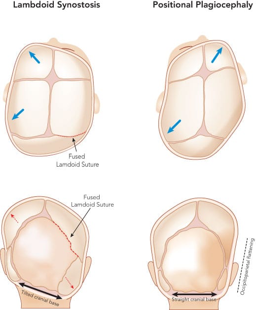 Synostotic lamdoid plagiocephaly vs positional plagiocephaly