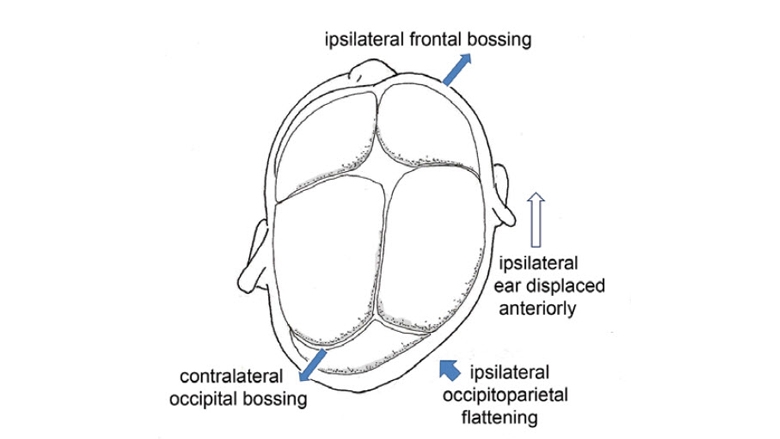 Changes of the skull in positional plagiocephaly