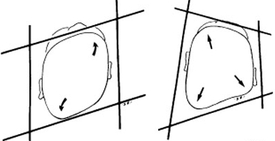 Head-shape when viewed from the vertex