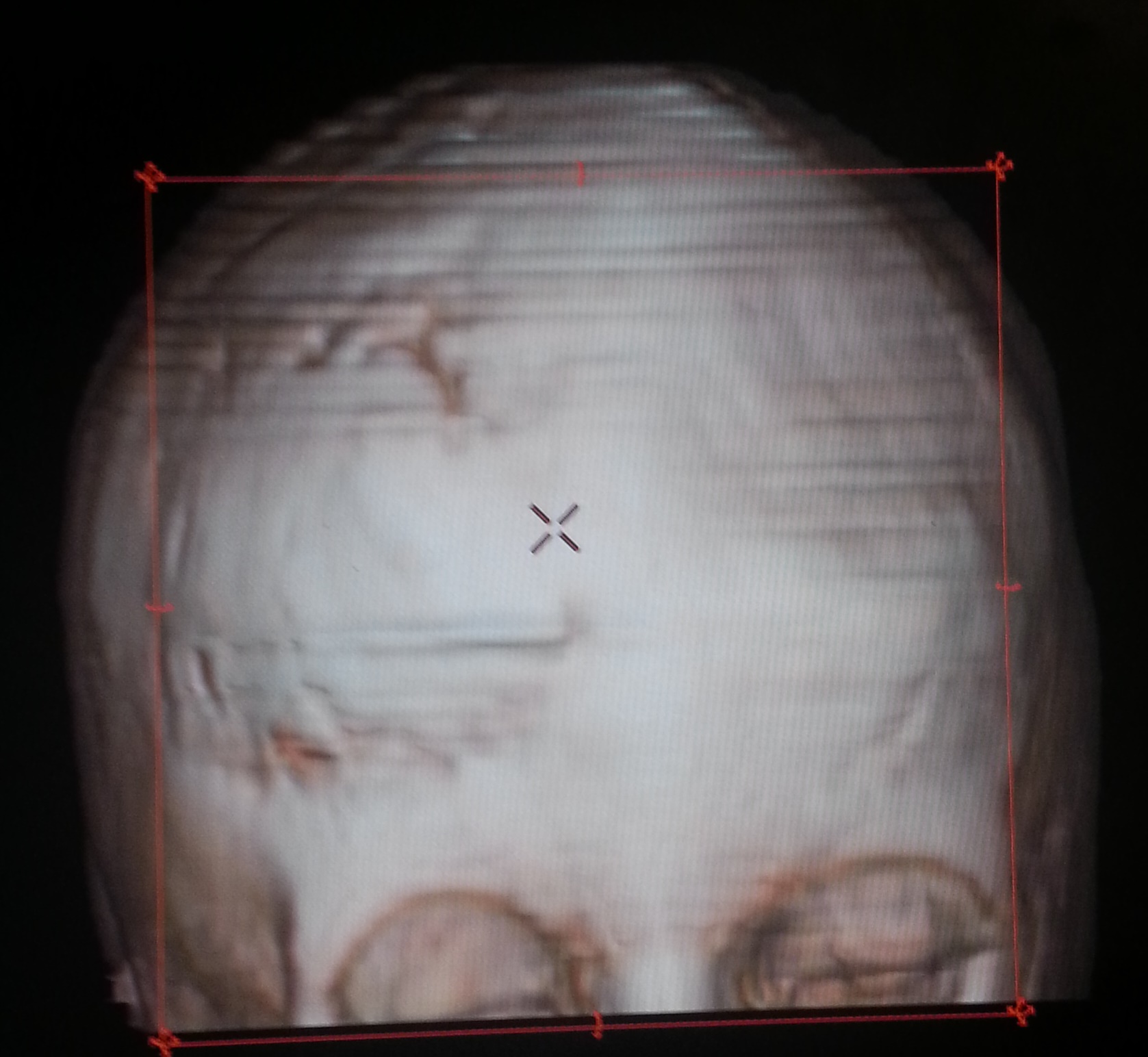 Three-dimentional CT, 5 years after craniotomy and remodelling for coronal synostosis, showing good skull shape.