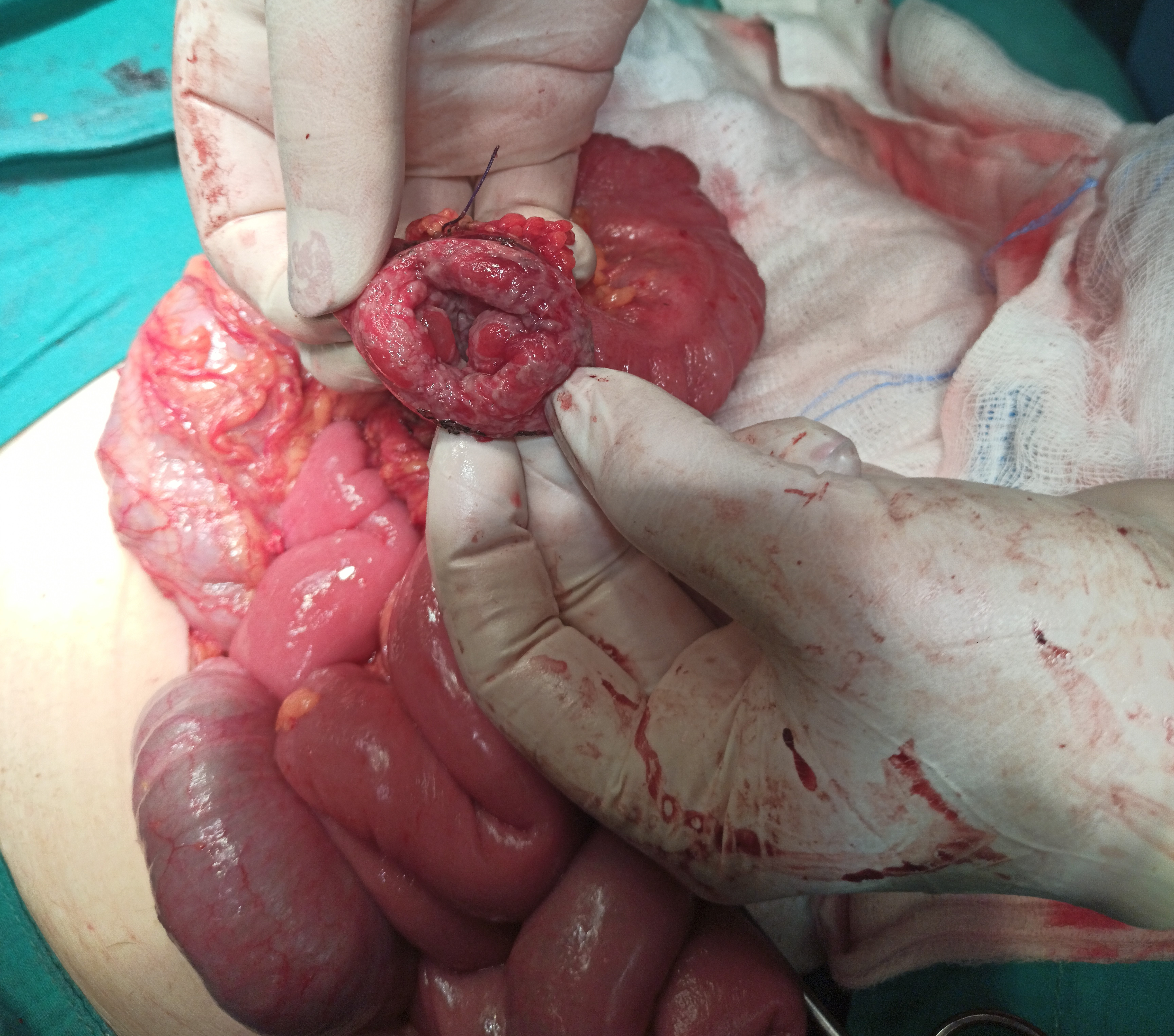 <p>Subtotal Colectomy in Severe Crohn Colitis.</p>