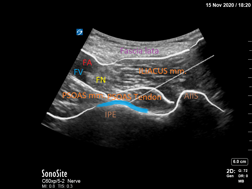 Relevant sonoanatomy for PENG block (FA= femoral artery; FV = femoral vein; FN= femoral nerve AIIS = antero inferior iliac sp