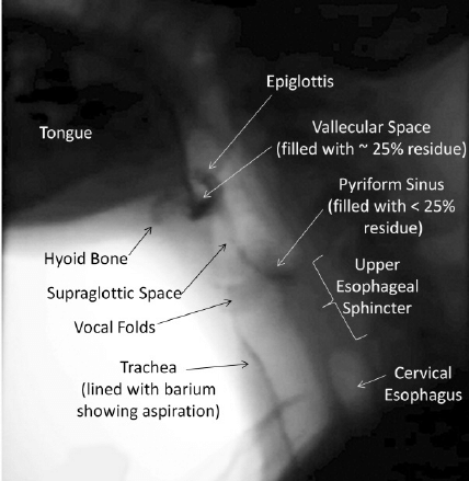 A still x-ray image, taken from a videofluoroscopic swallowing study. This image shows the oropharyngeal anatomy, and includes evidence of mild residue (up to 25% of the available space) in the valleculae and pyriform sinuses. Additionally, evidence of prior aspiration is evident as a thin line of barium running down the front wall of the trachea.
