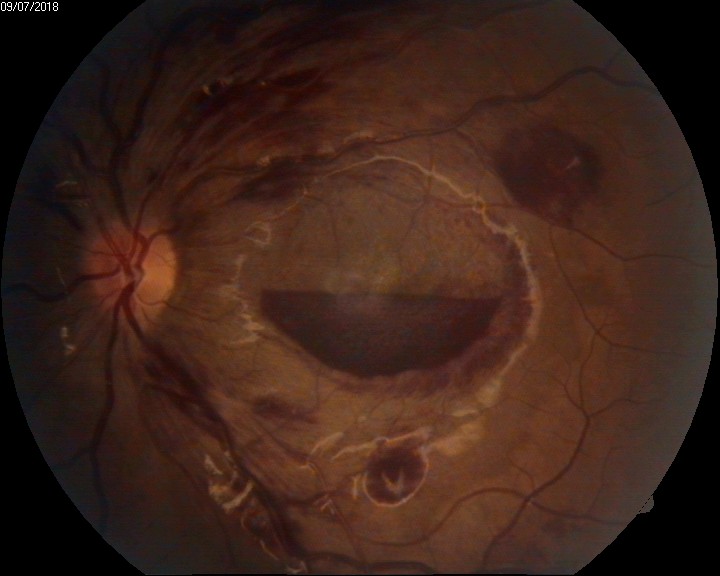 intraocular hemorrhage - anaemic retinopathy