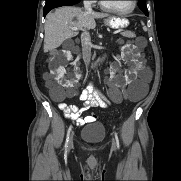 CT scan of the abdomen shows Autosomal Dominant Polycystic disease 