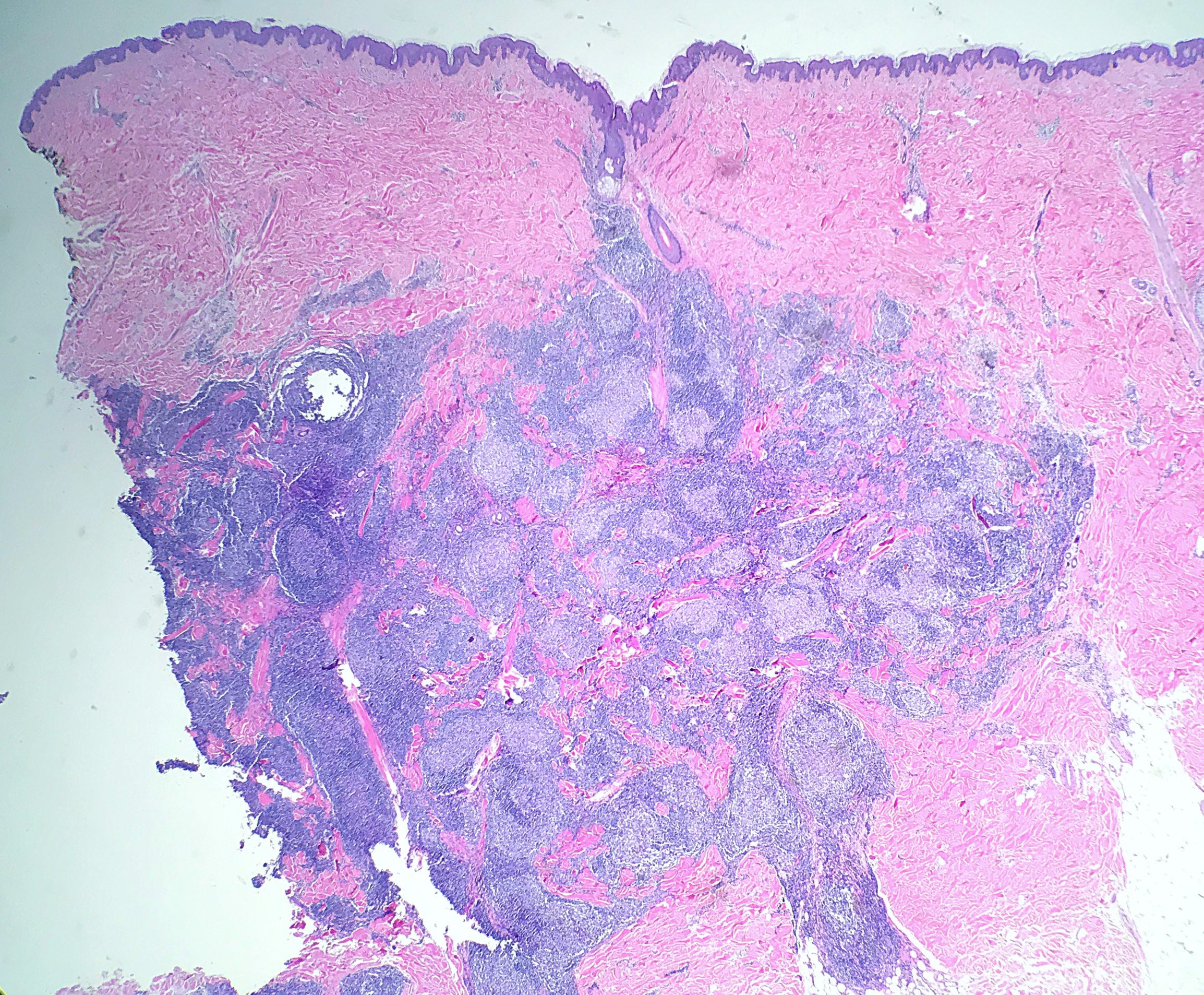 Primary cutaneous follicle center lymphoma demonstrating densely packed follicles in skin shave biopsy.
