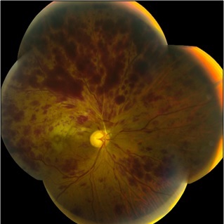 <p>Central Retinal Vein Occlusion</p>