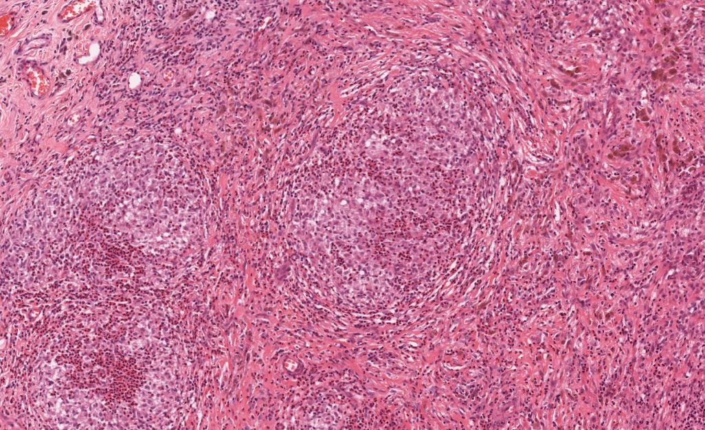 Langerhans cell histiocytosis, H/E 10x