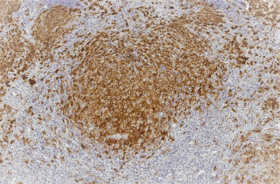 Langerhans cell histiocytosis, CD1a stain.