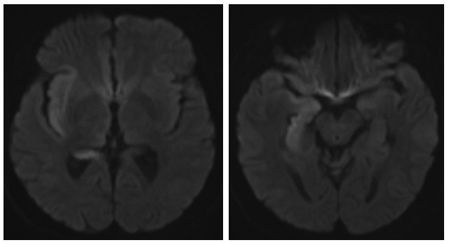 MRI brain showing diffusion restriction in right temporal and insular cortex. 
