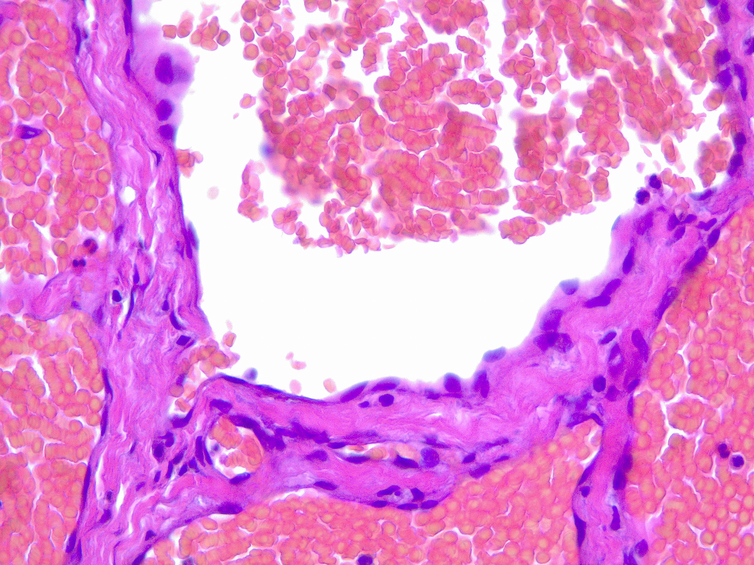 Hemangioma, H/E 20x. The image shows flattened endothelium lining a dilated vessel, engorged with erythrocytes.