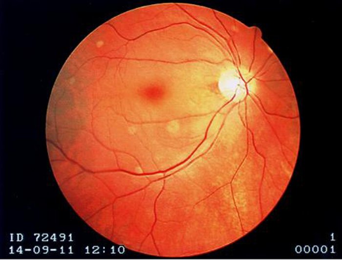 <p>Central Retinal Artery Occlusions