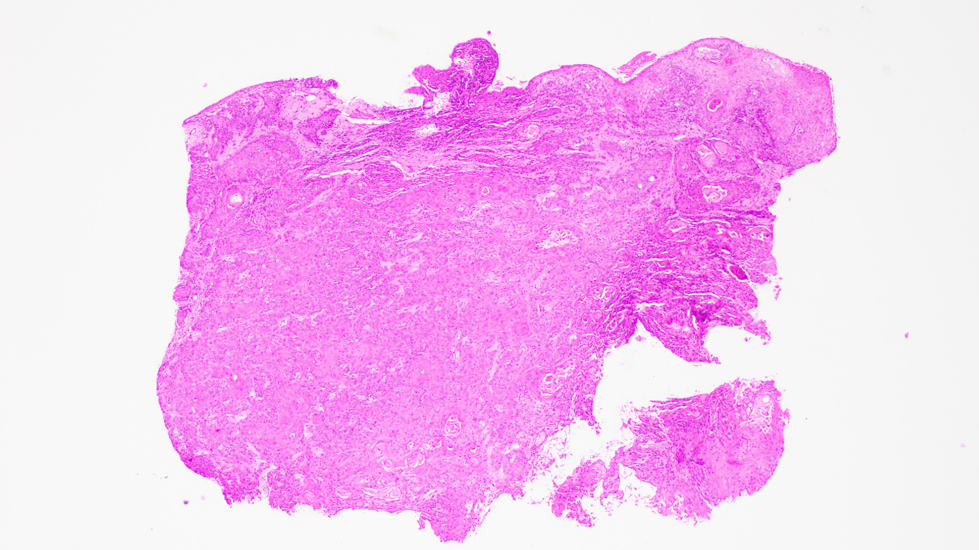 <p>Vulvar Squamous Cell Carcinoma