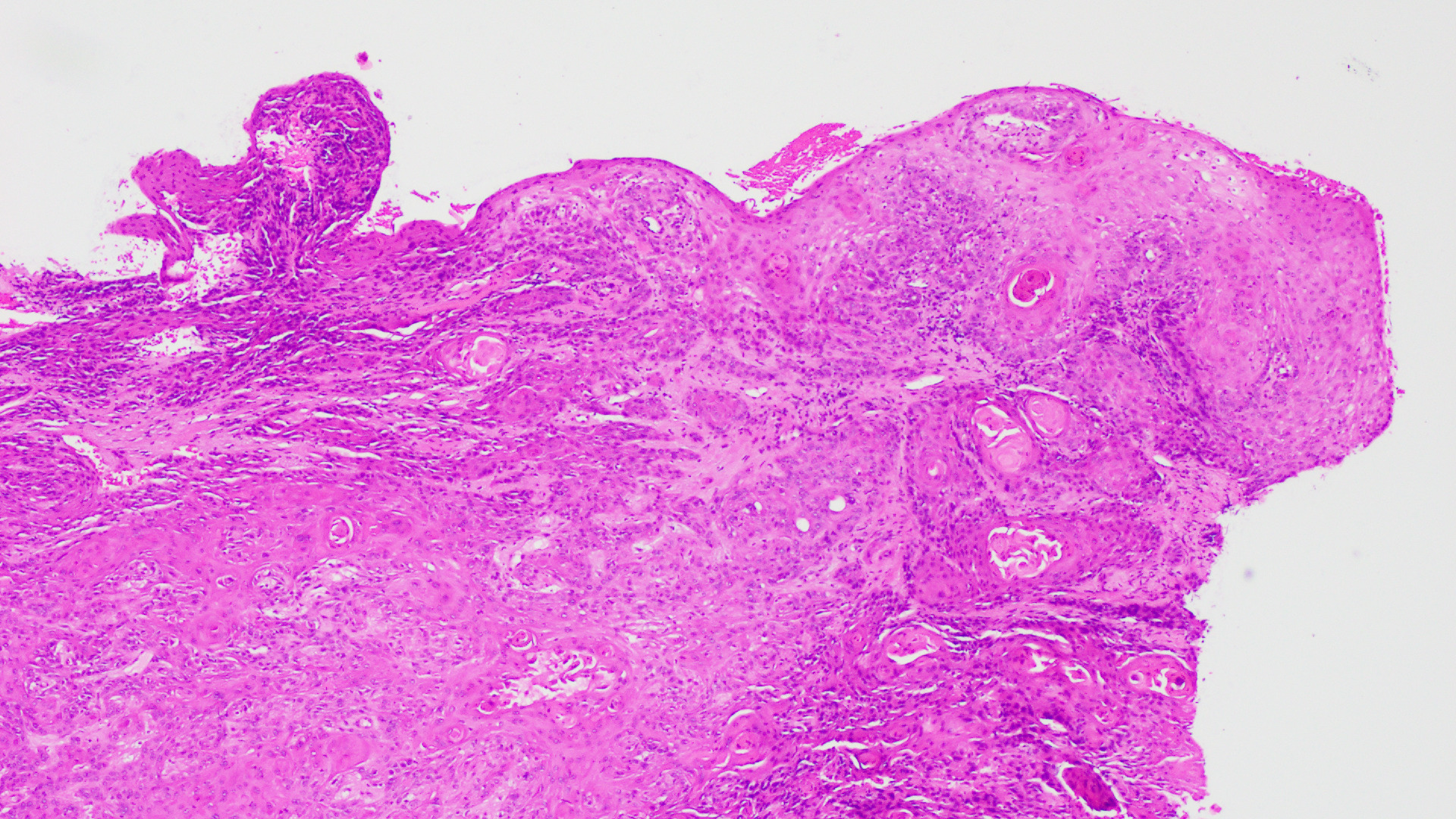 Histopathology Image of Vulvar Squamous Cell Carcinoma Low Power Field, H&E stain, showing keratinized pearls. 