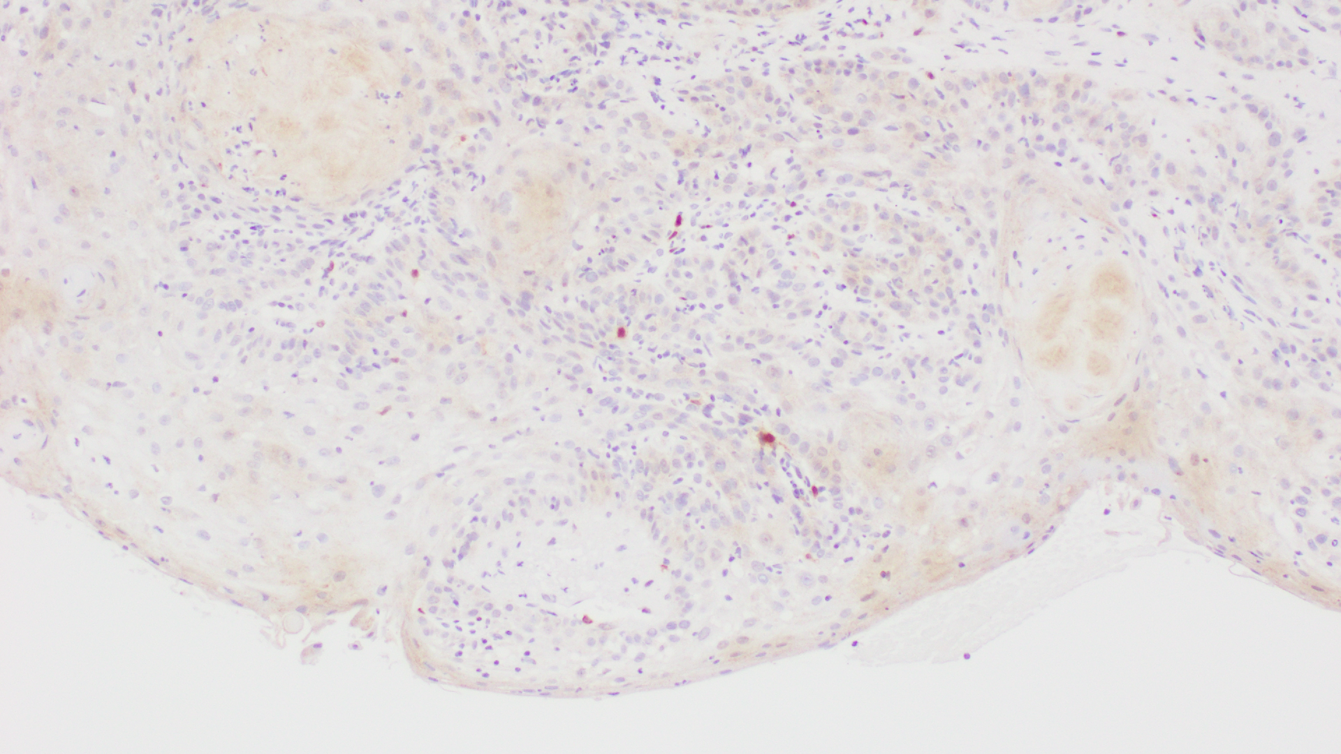 Histopathology Slide of Vulvar Squamous Cell Carcinoma with P16 stain, showing positivity for Human Papilloma virus(HPV 16). 